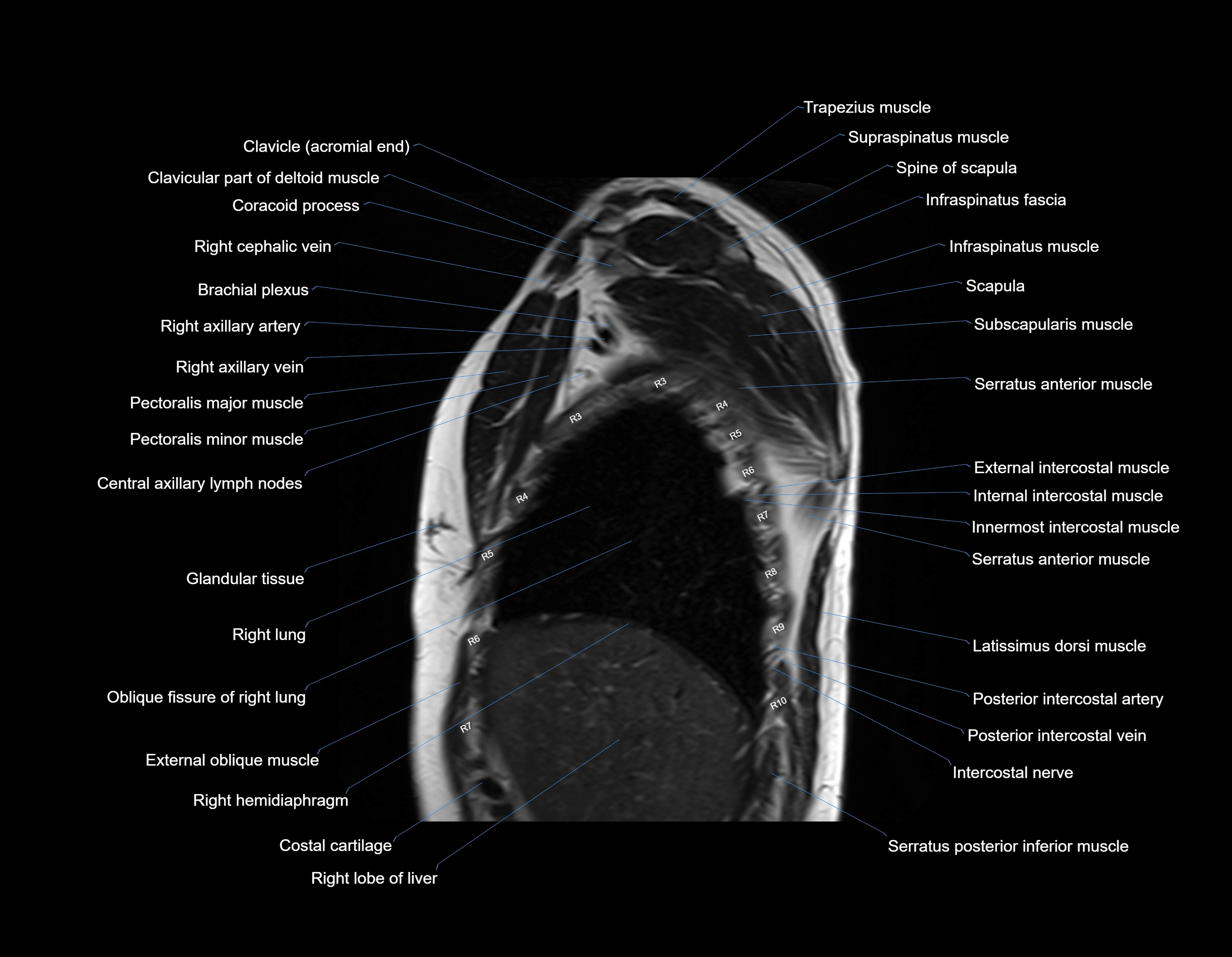 MRI chest (thorax) sagittal labelled cross sectional anatomy 3T radiology image-img-00001-00007.webp